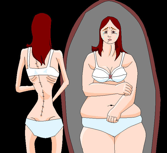 anorexie - troubles des comportements alimentaires